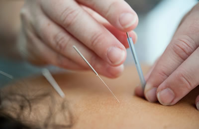 Acupunctuur